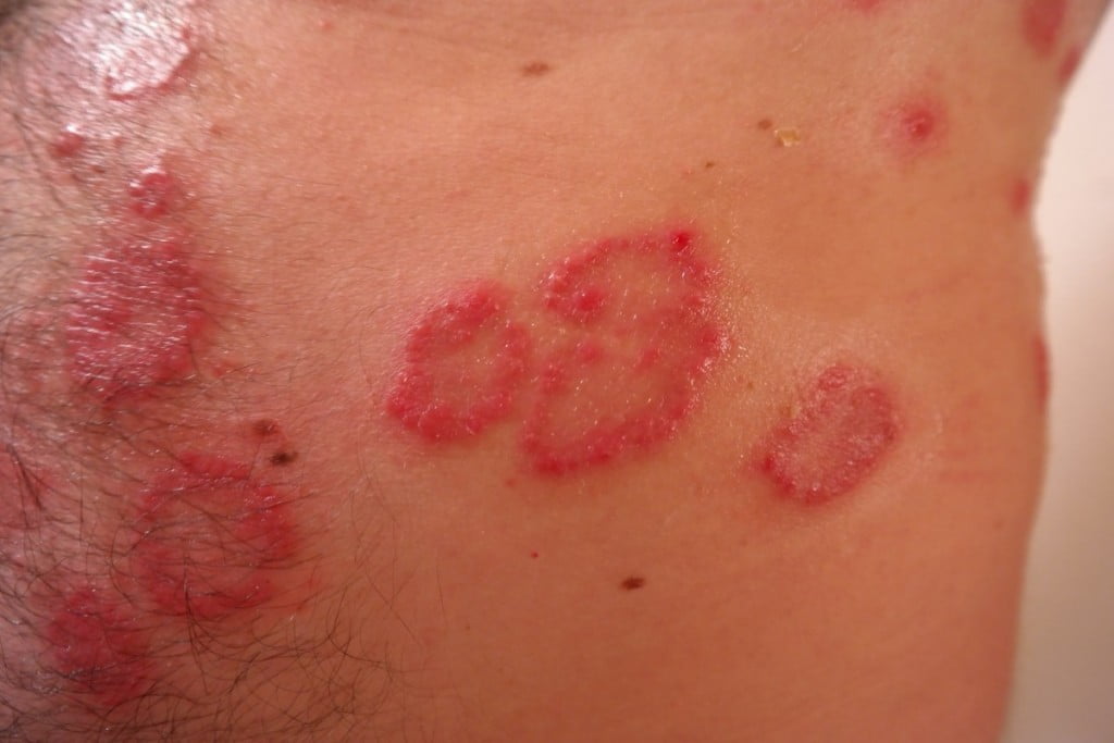 Luskavica ali psoriaza - življenje z njo