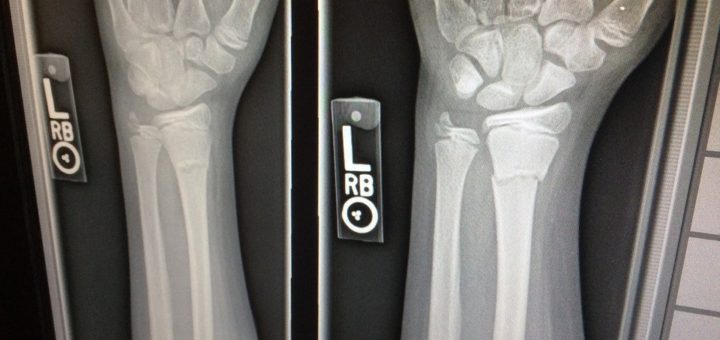 Osteoporoza - ko se kosti lomijo