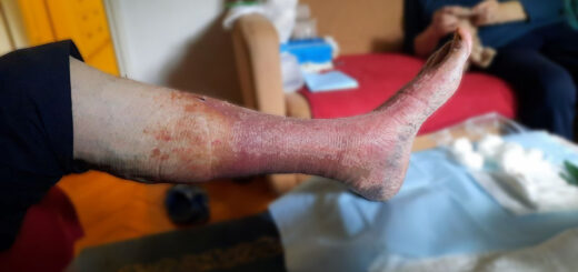 Kronično vensko popuščanje